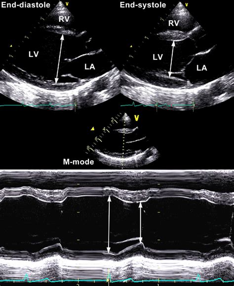 lv end systolic diameter|left internal dimension in systole.